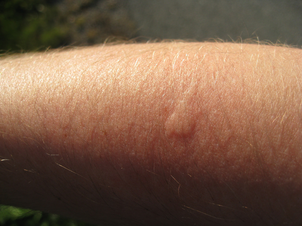 Bug Bites 3